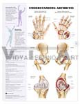 Understanding Arthritis Anatomical Chart